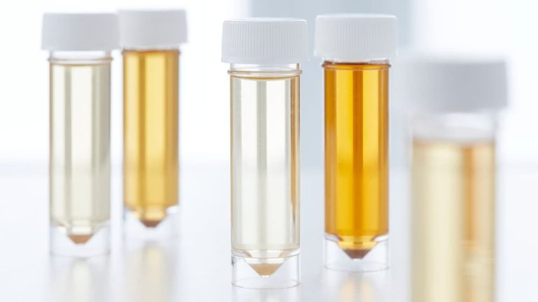 Mostră de urină sursa foto:SCIENCE PHOTO LIBRARY/Getty Images